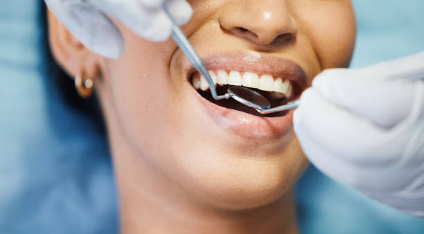 Best Knocked-Out Tooth (Avulsed Tooth) Treatment in Moncks Corner, SC